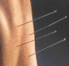 Acupuncture at Axis Health